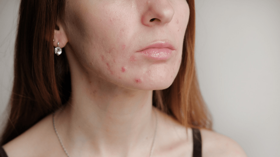 MACQUEZA Guide: Dealing with Mask Acne
